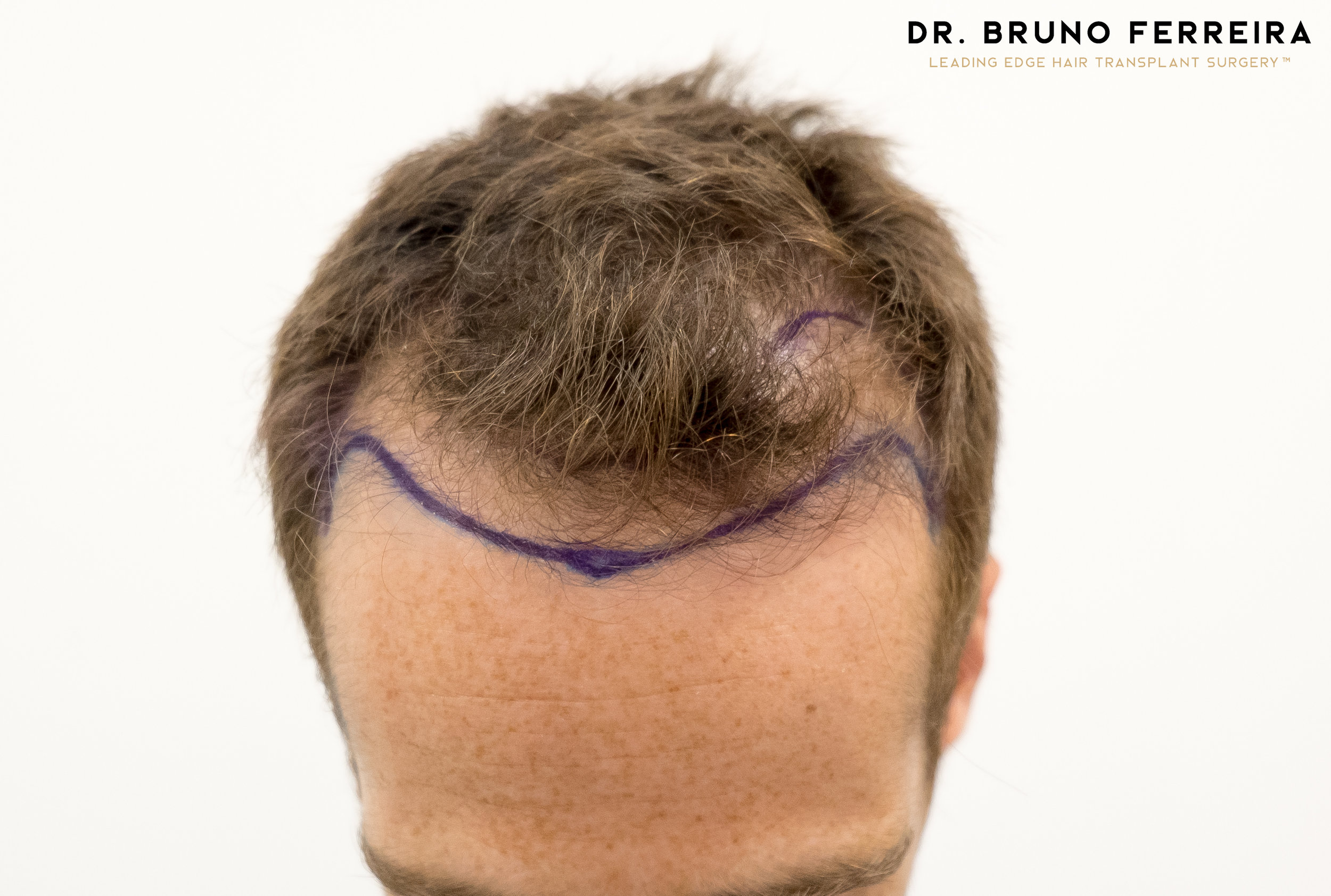FUE — Dr. Bruno Ferreira
