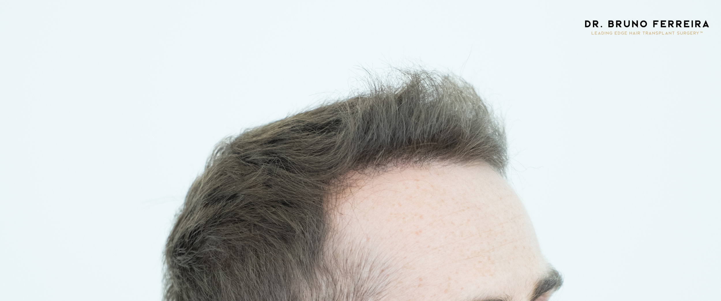 FUE — Dr. Bruno Ferreira