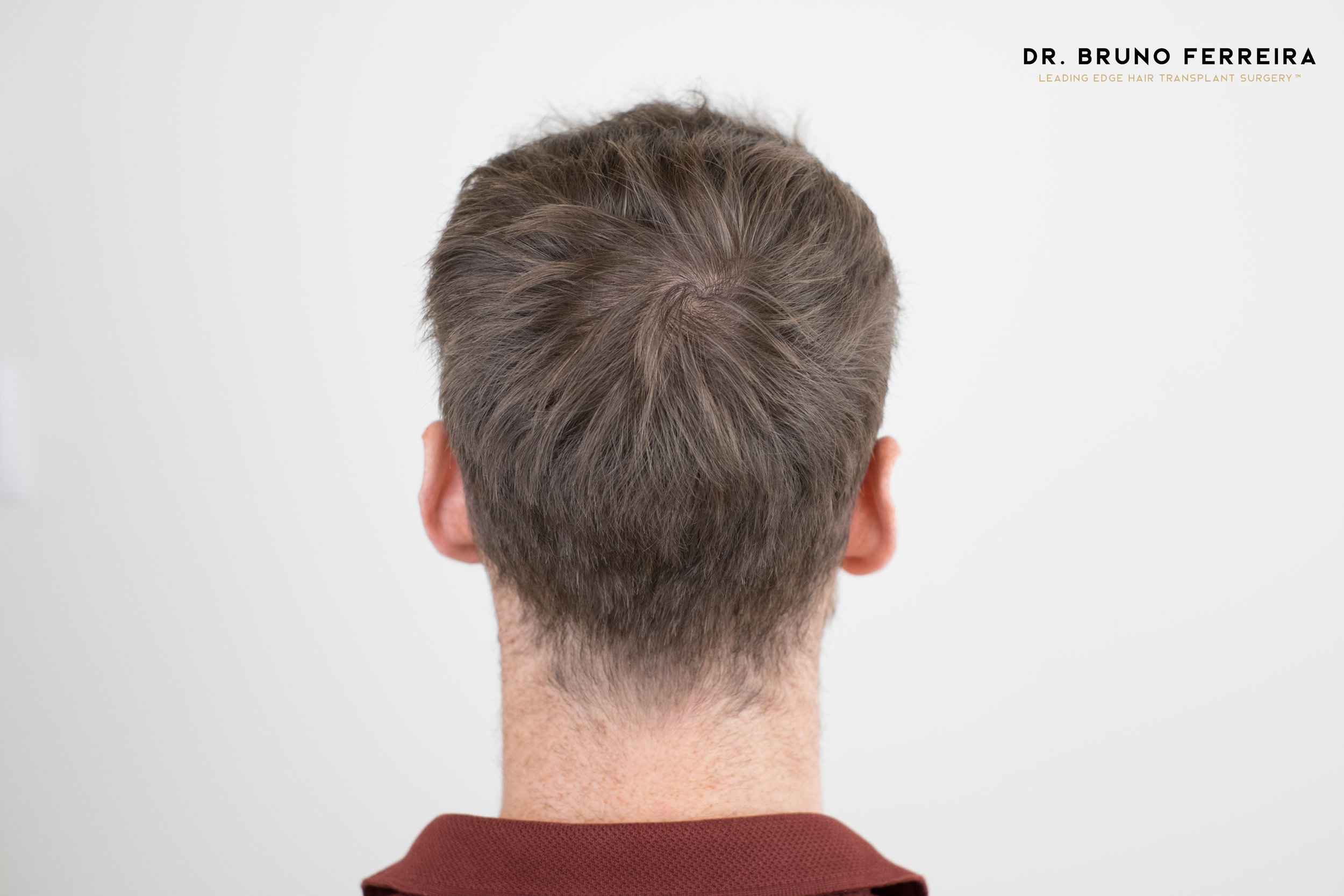 FUE — Dr. Bruno Ferreira