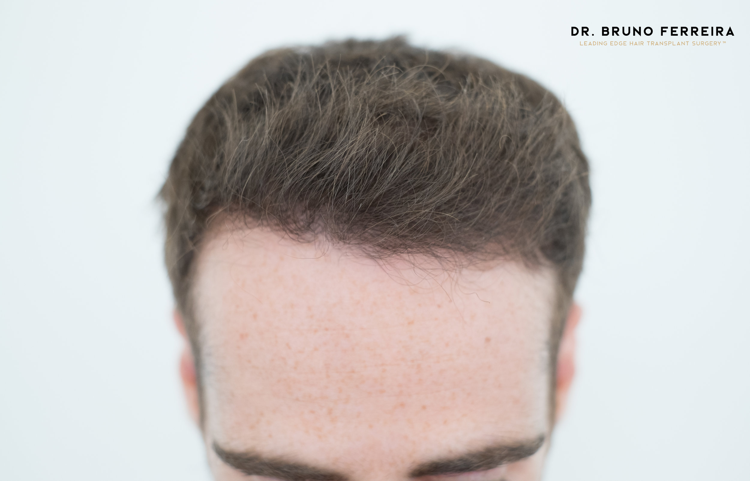 FUE — Dr. Bruno Ferreira
