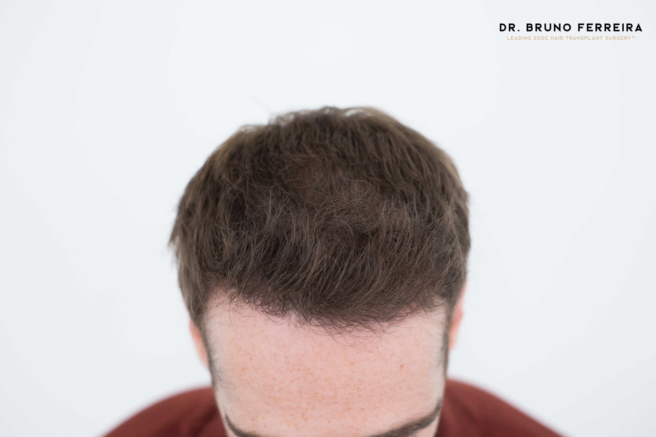FUE — Dr. Bruno Ferreira