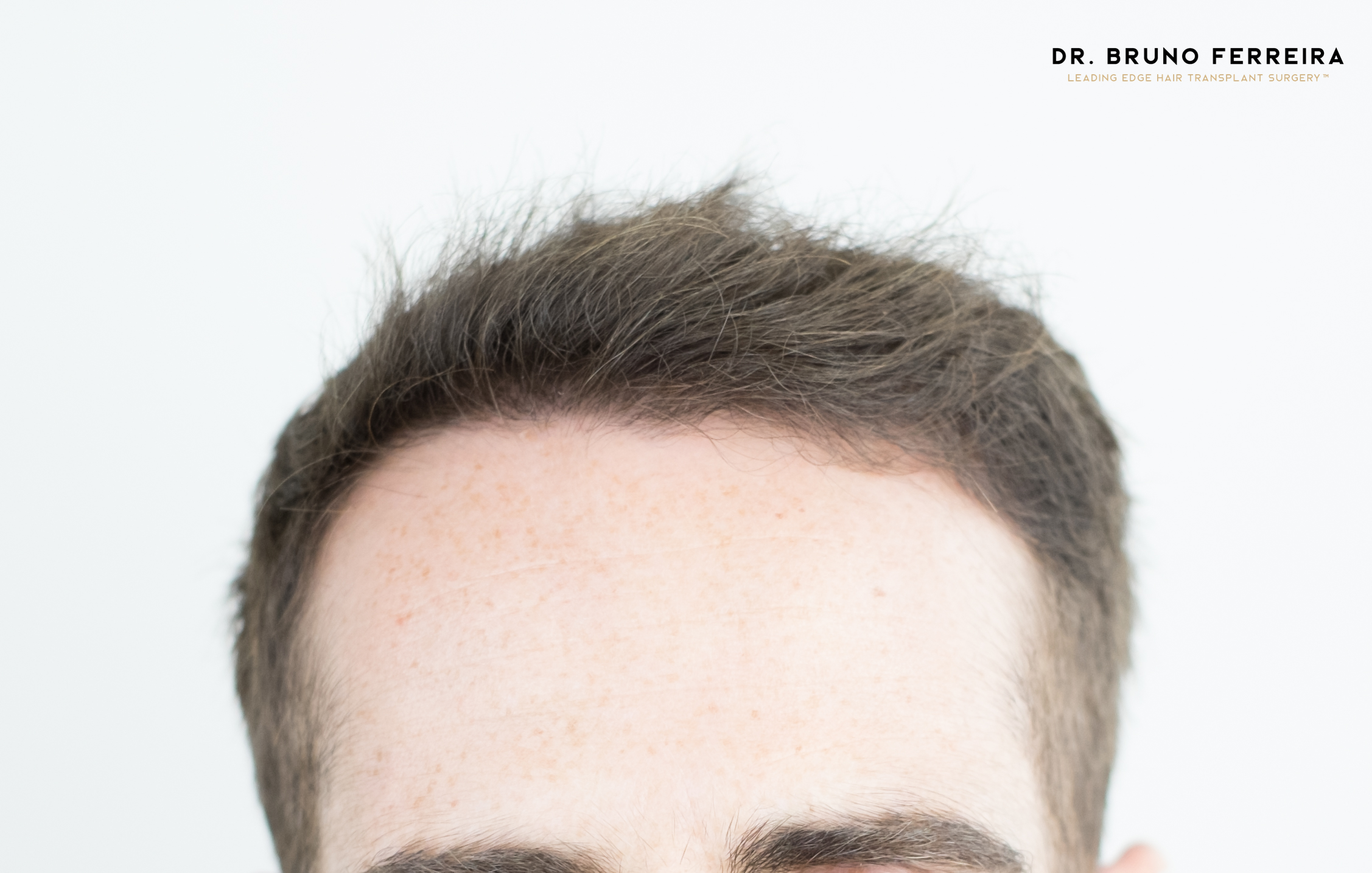 FUE — Dr. Bruno Ferreira