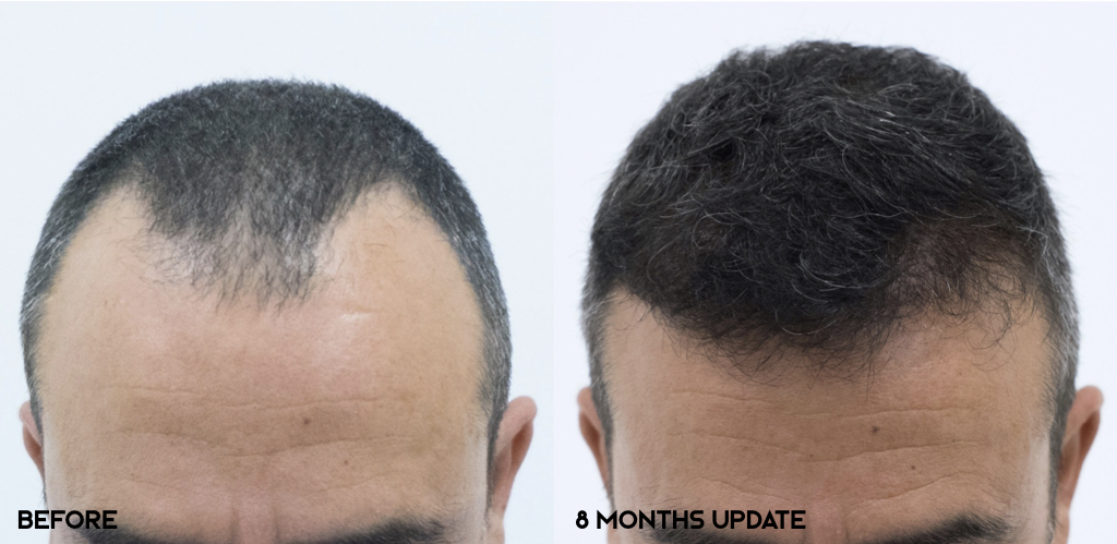 FUE — Dr. Bruno Ferreira