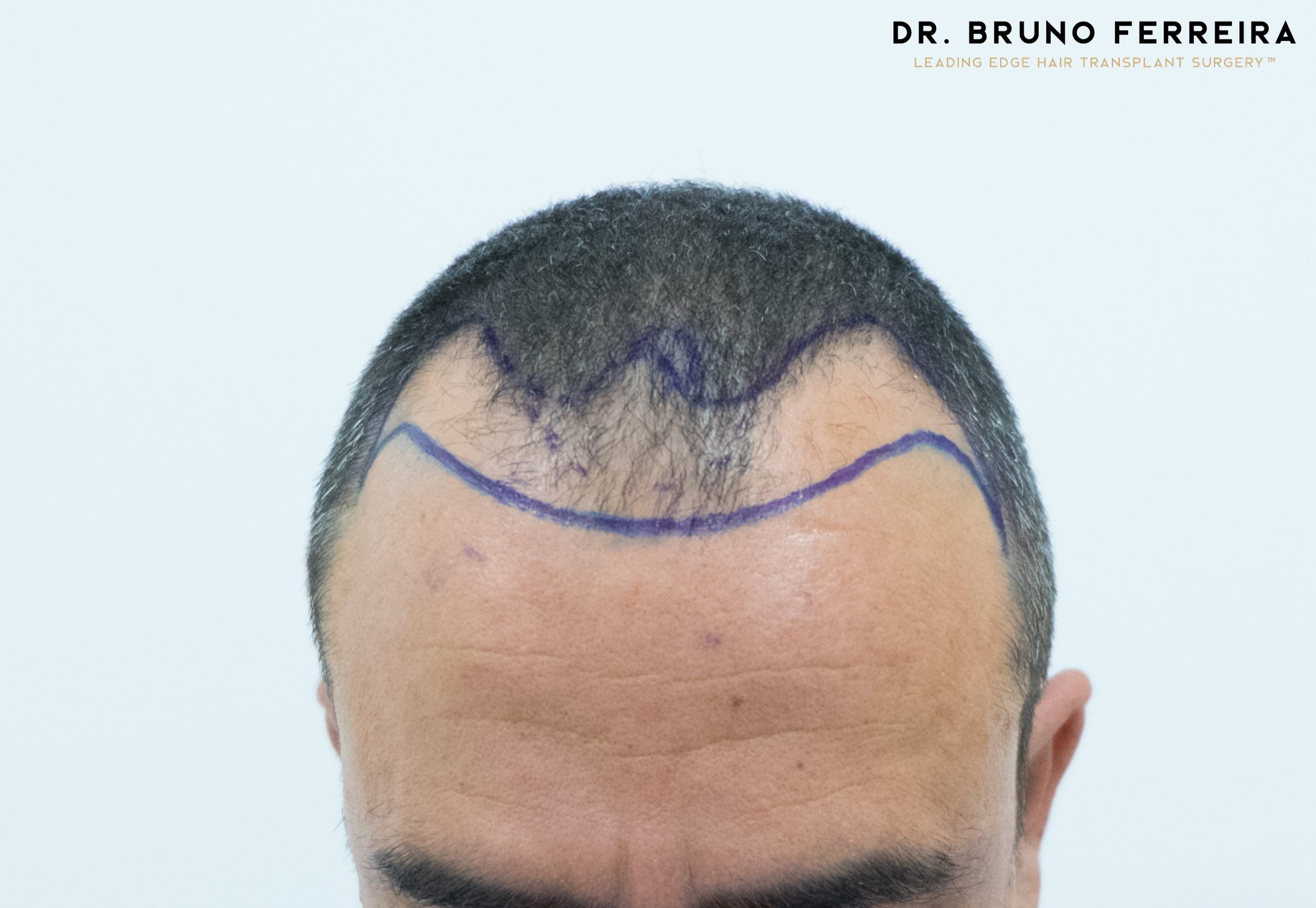 FUE — Dr. Bruno Ferreira