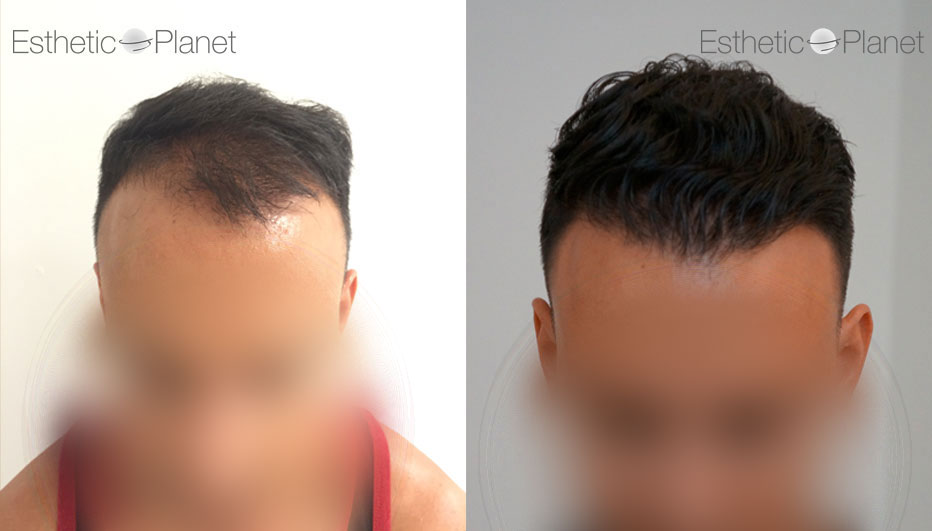 FUE — Dr Ergin Er - FUE & DHI team