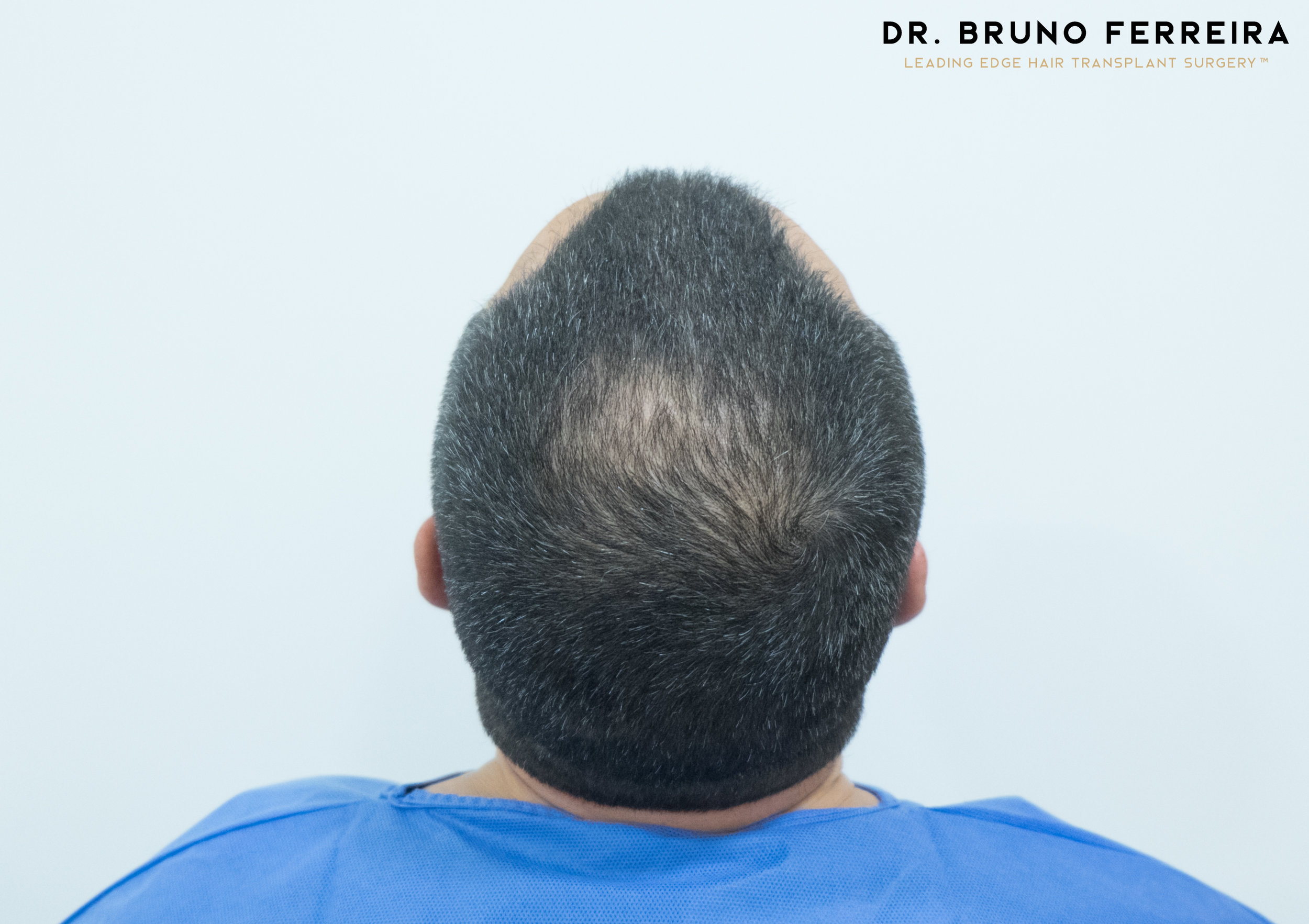 FUE — Dr. Bruno Ferreira