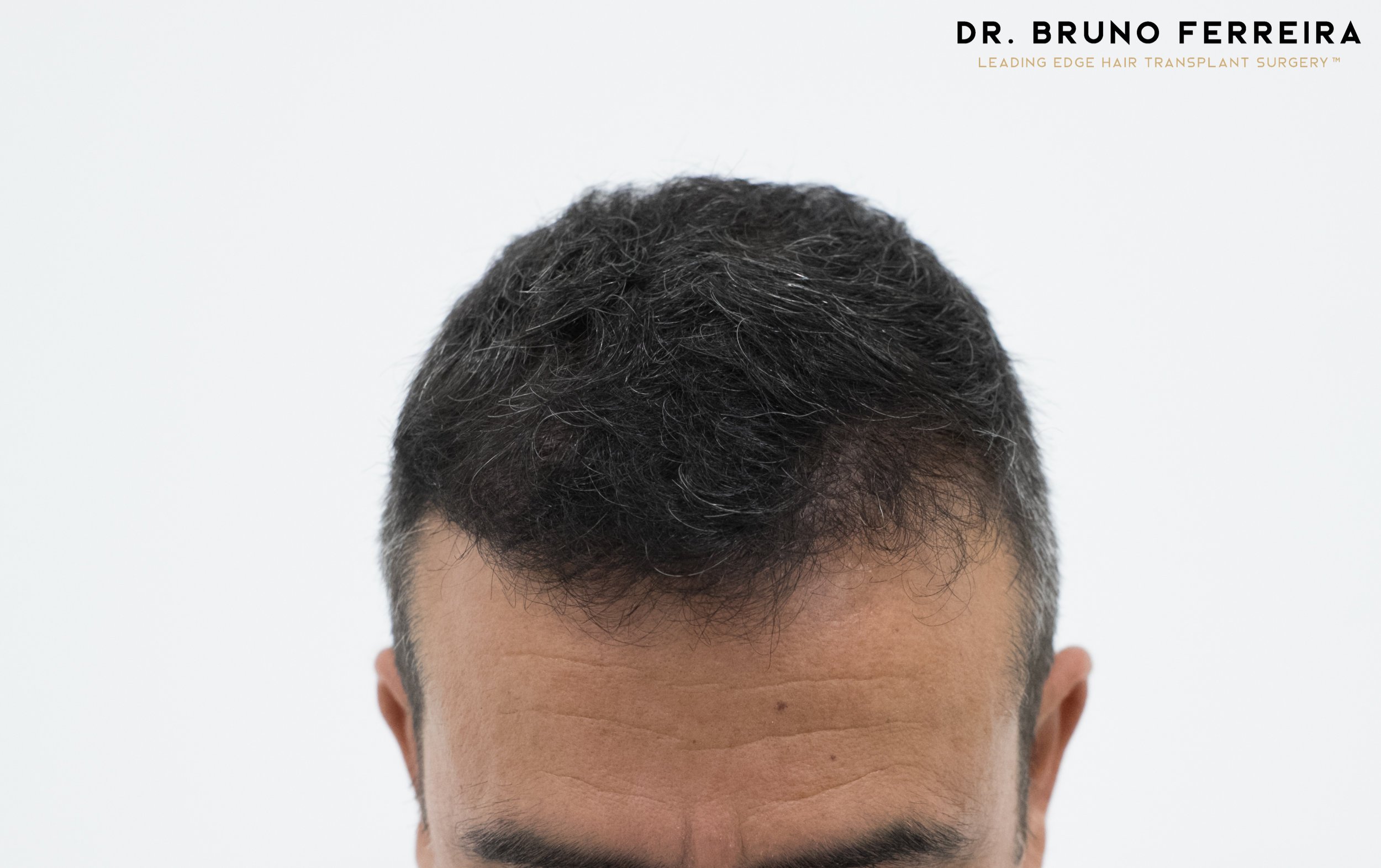 FUE — Dr. Bruno Ferreira