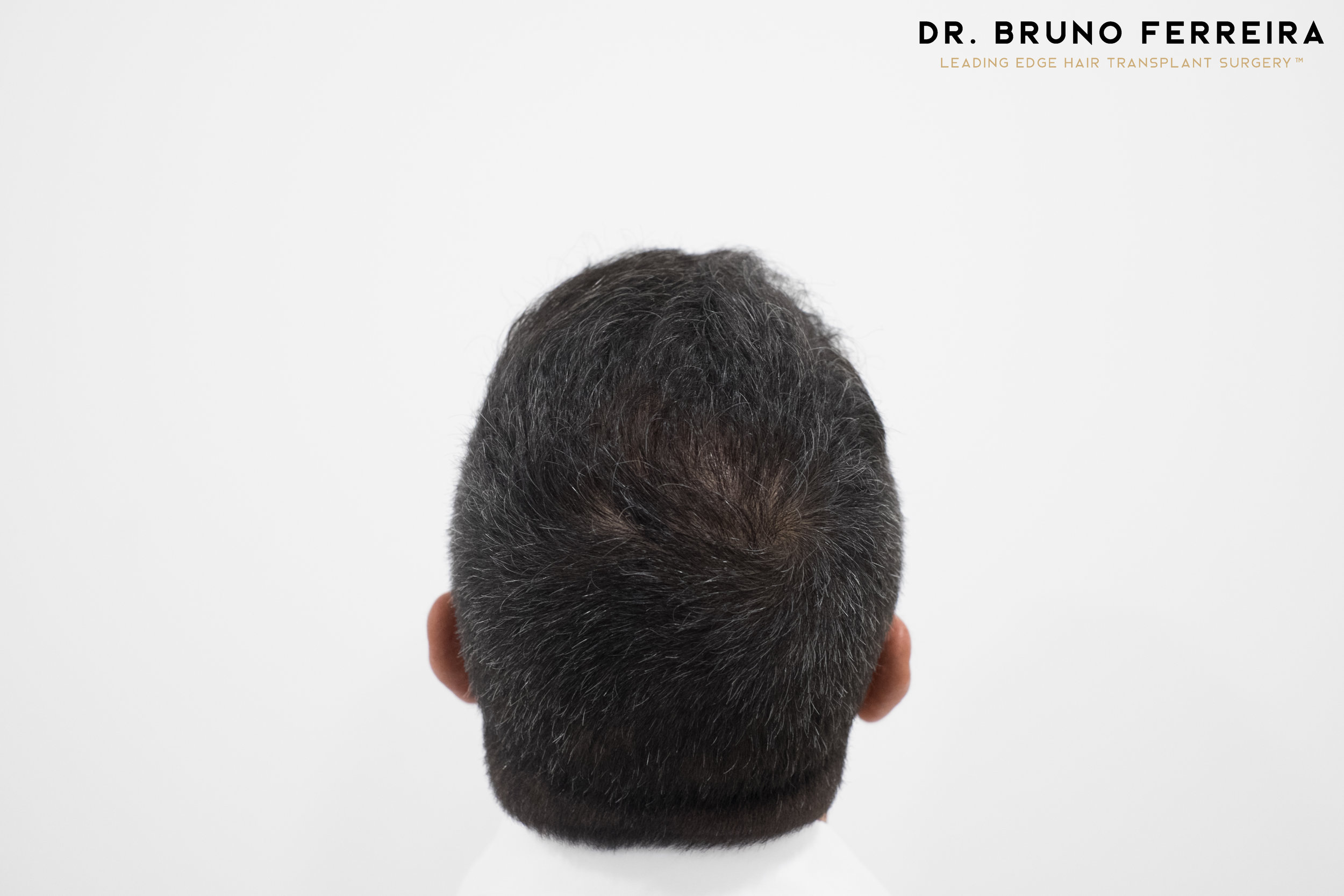 FUE — Dr. Bruno Ferreira
