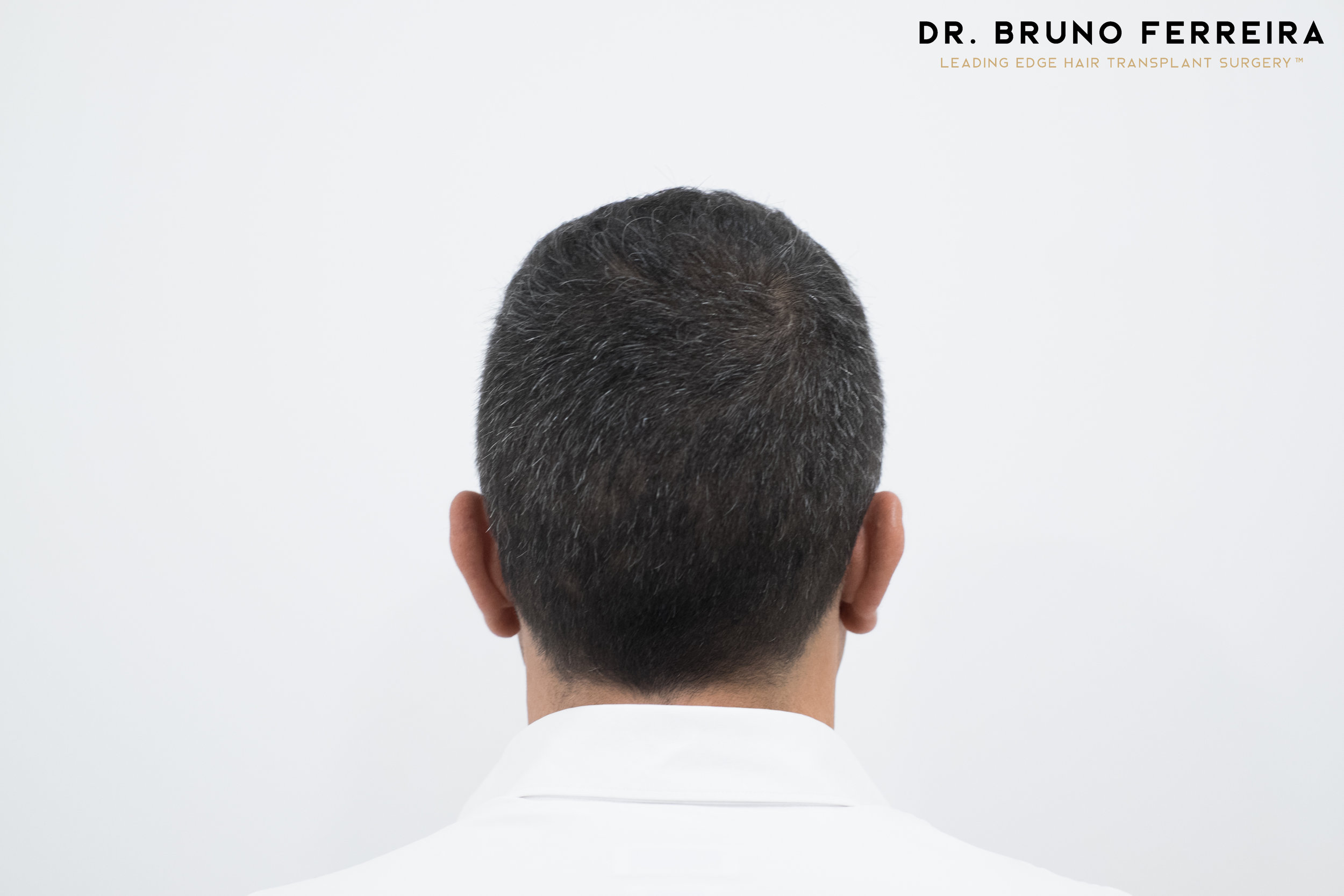 FUE — Dr. Bruno Ferreira