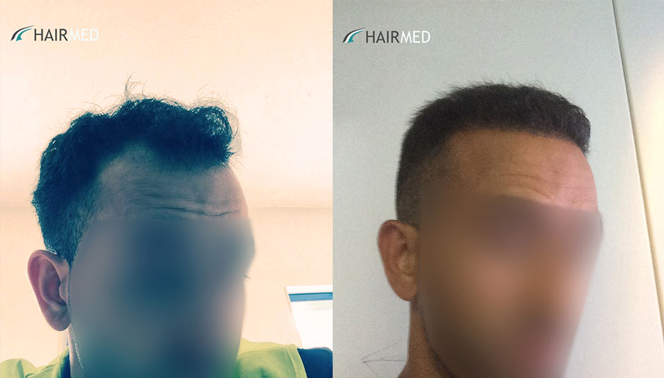 FUE — Dr Ergin Er - FUE & DHI team