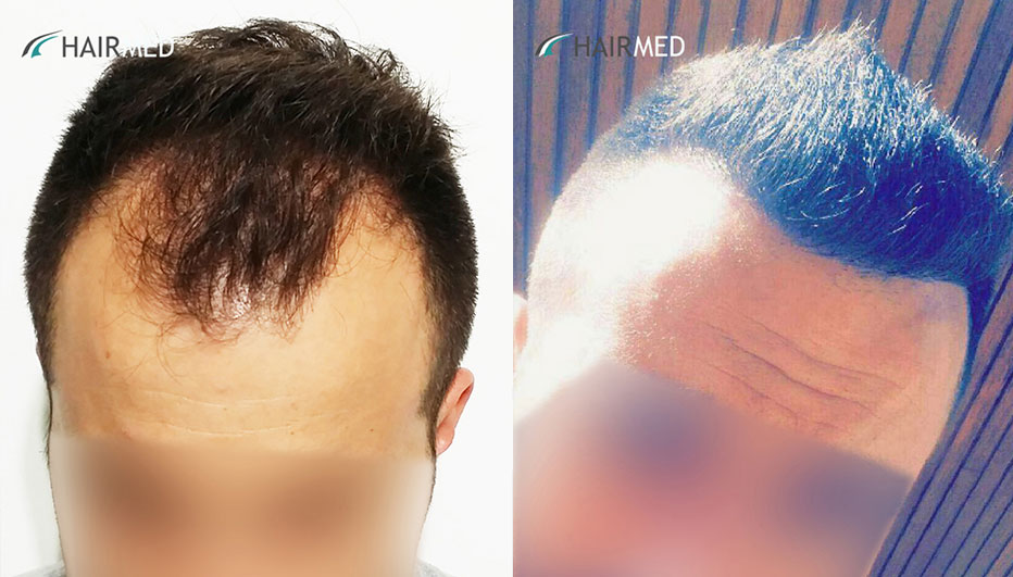 FUE — Dr Ergin Er - FUE & DHI team