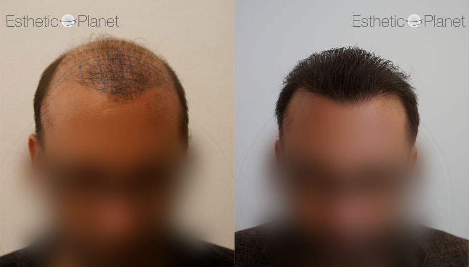 FUE — Dr Ergin Er - FUE & DHI team