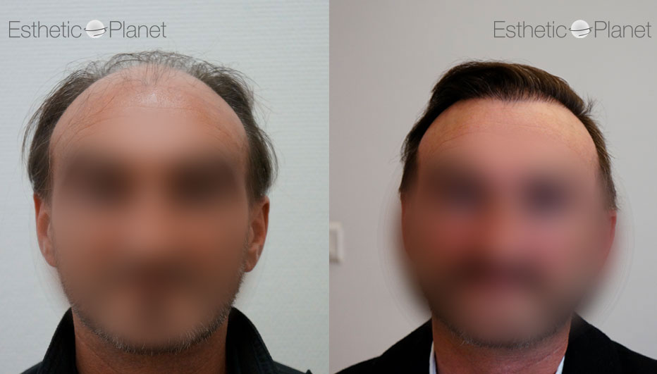 FUE — Dr Ergin Er - FUE & DHI team