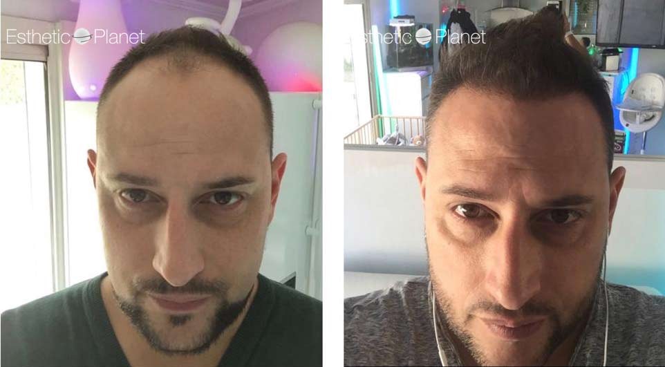 FUE — Dr Ergin Er - FUE & DHI team
