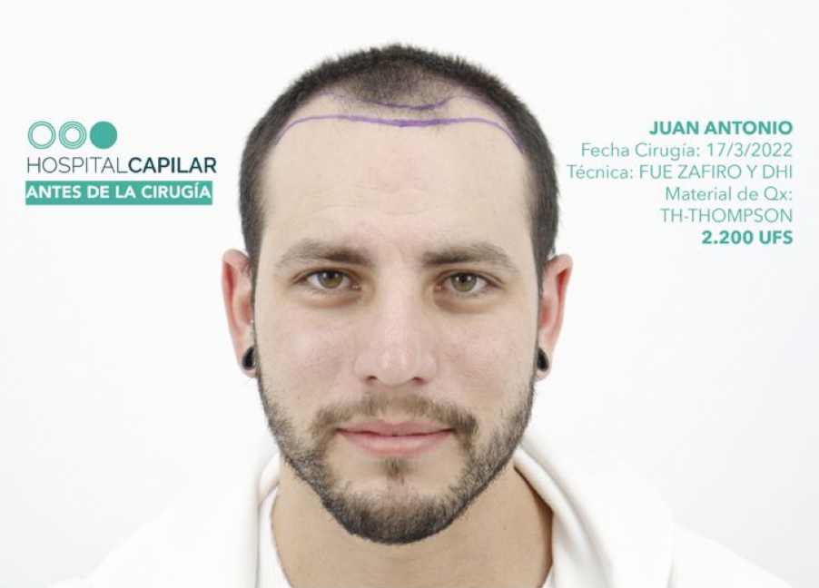 FUE — Hospital Capilar Madrid