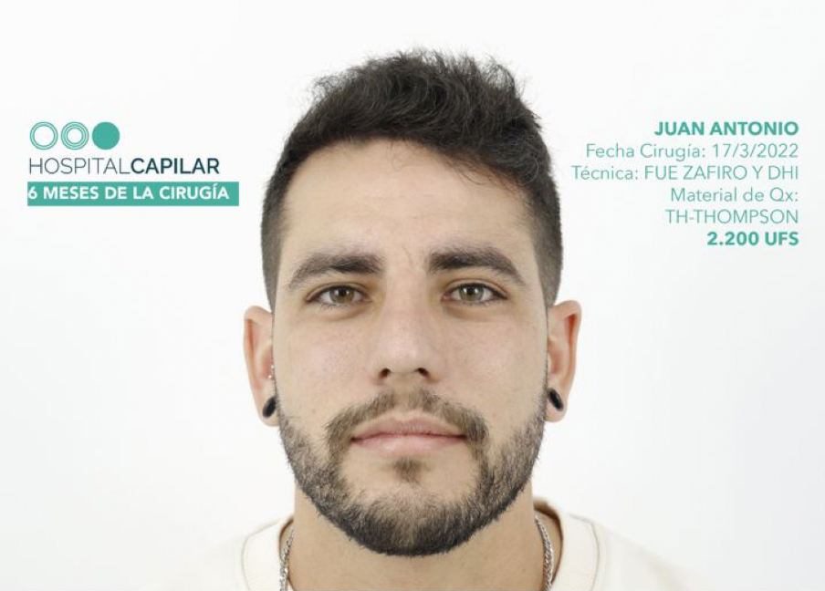 FUE — Hospital Capilar Madrid