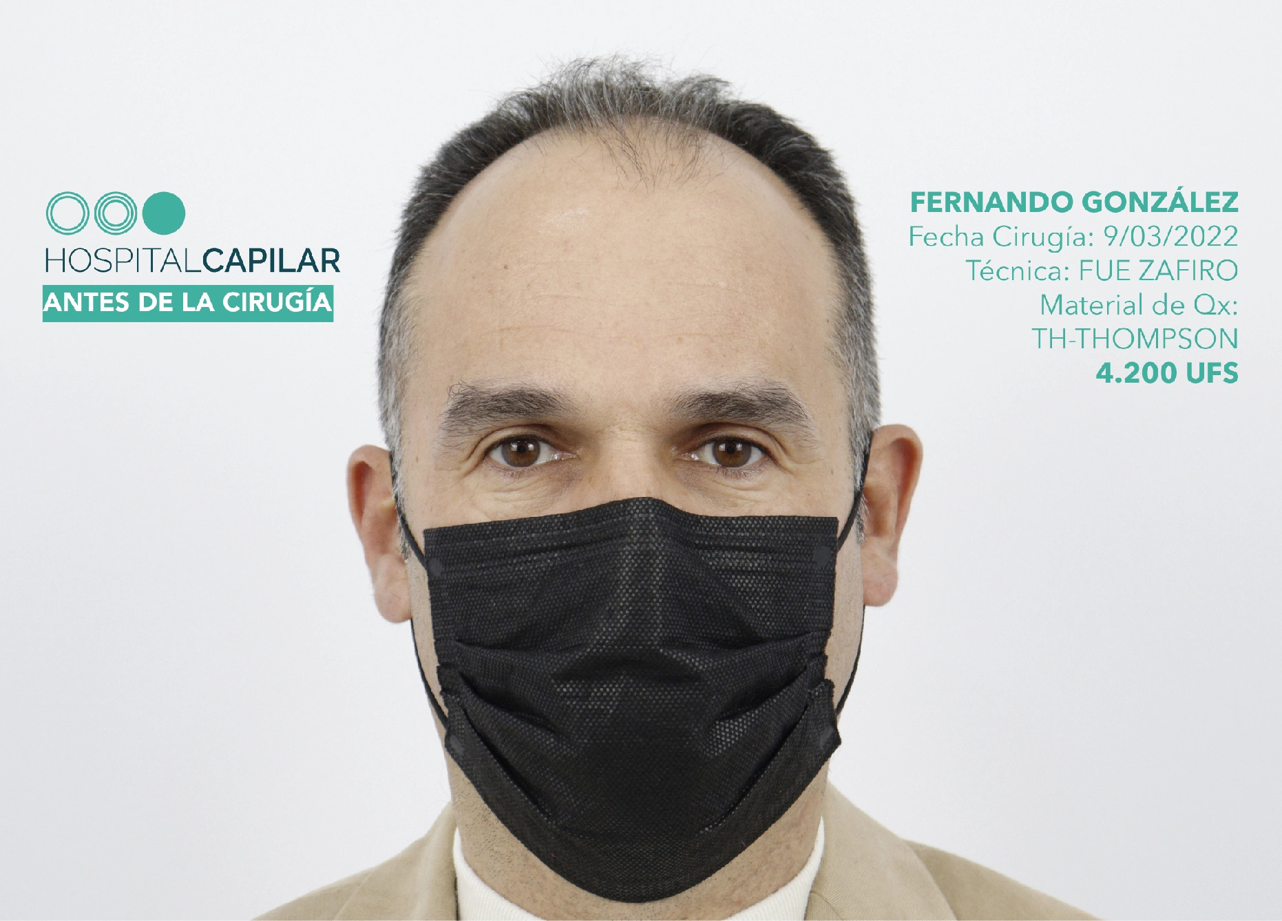 FUE — Hospital Capilar Madrid