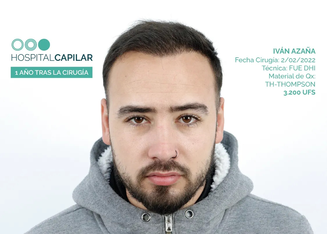 FUE — Hospital Capilar Madrid