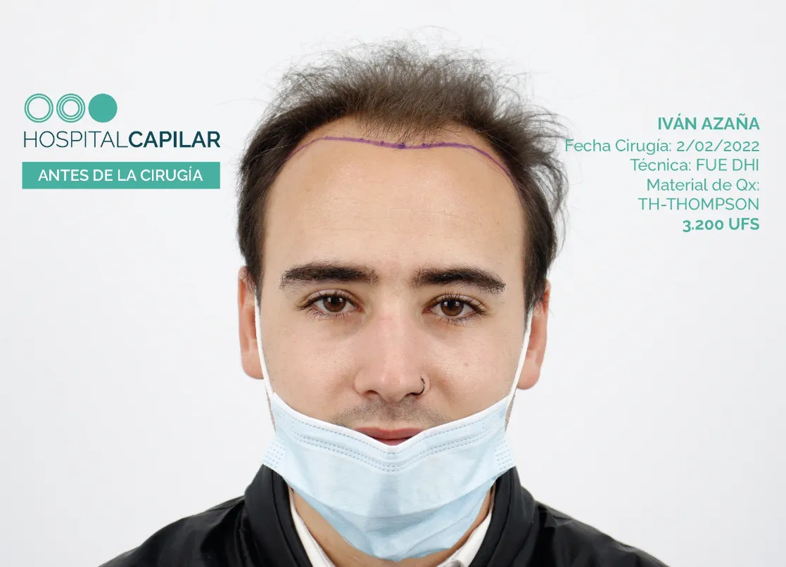 FUE — Hospital Capilar Madrid