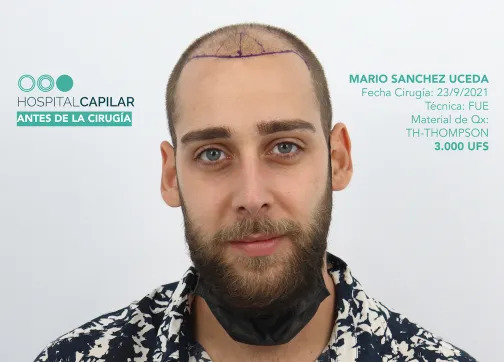 FUE — Hospital Capilar Madrid