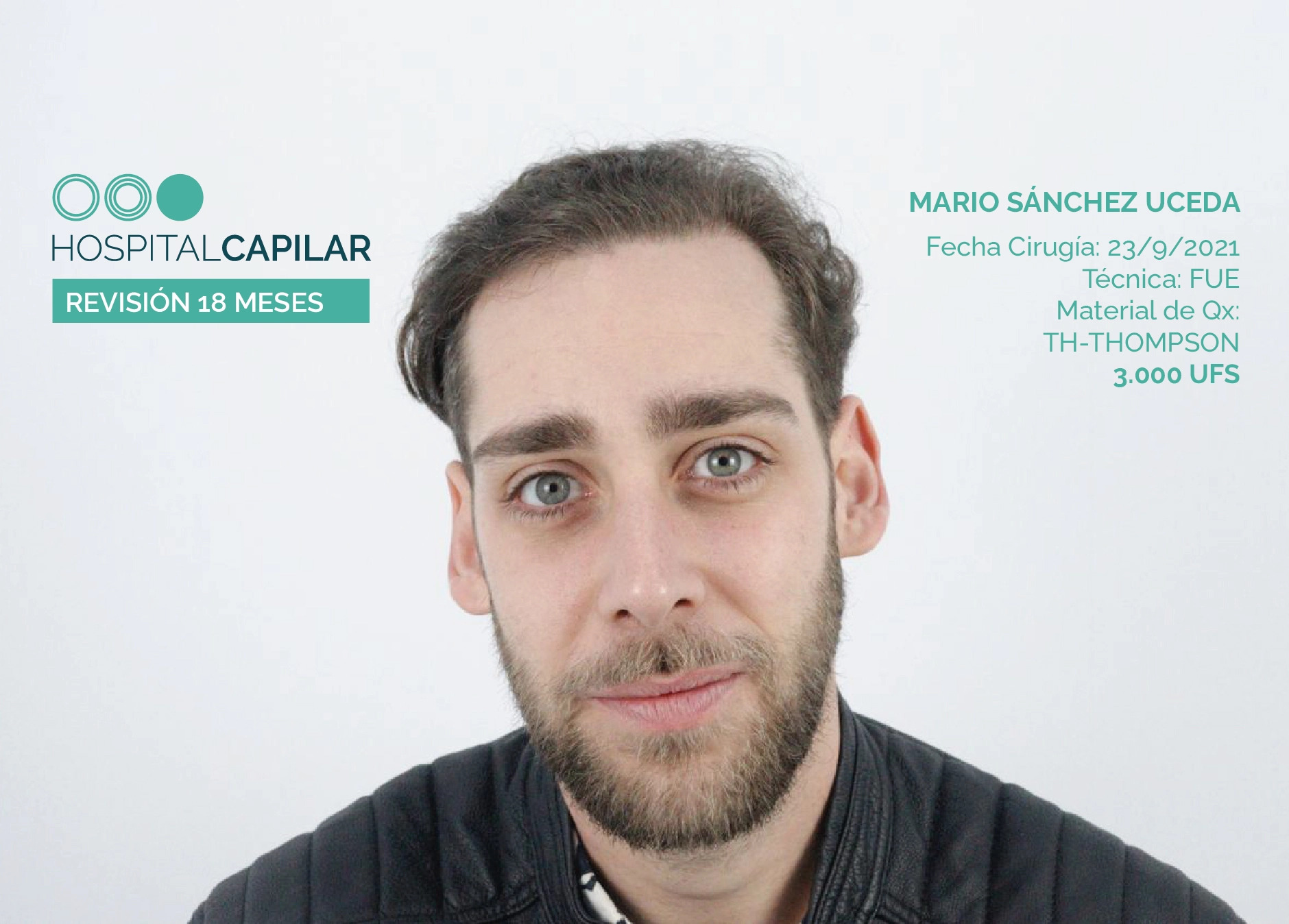 FUE — Hospital Capilar Madrid
