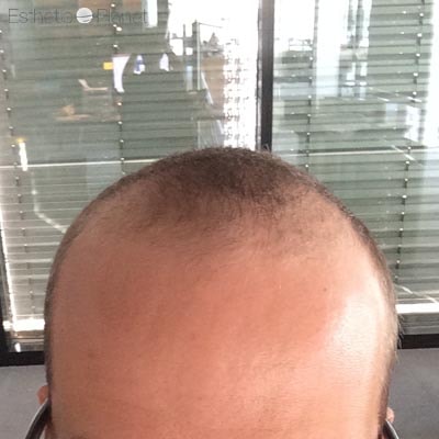 FUE — Dr Ergin Er - FUE & DHI team