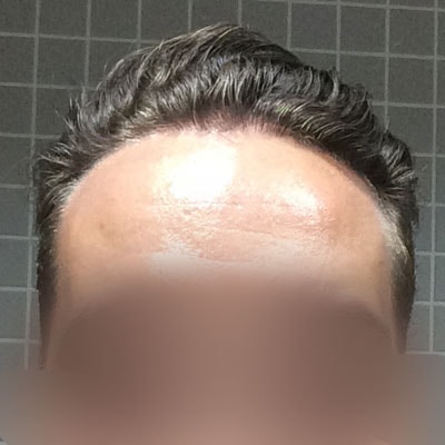 FUE — Dr Ergin Er - FUE & DHI team