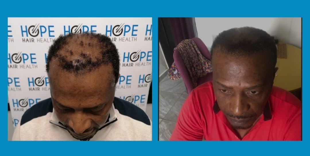 AFRO FUE — Hope Hair Health