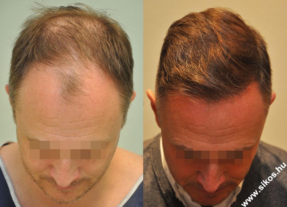 FUE — Dr. Sikos Geza Clinic