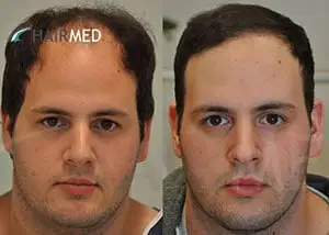 FUE — Dr. Sikos Geza Clinic