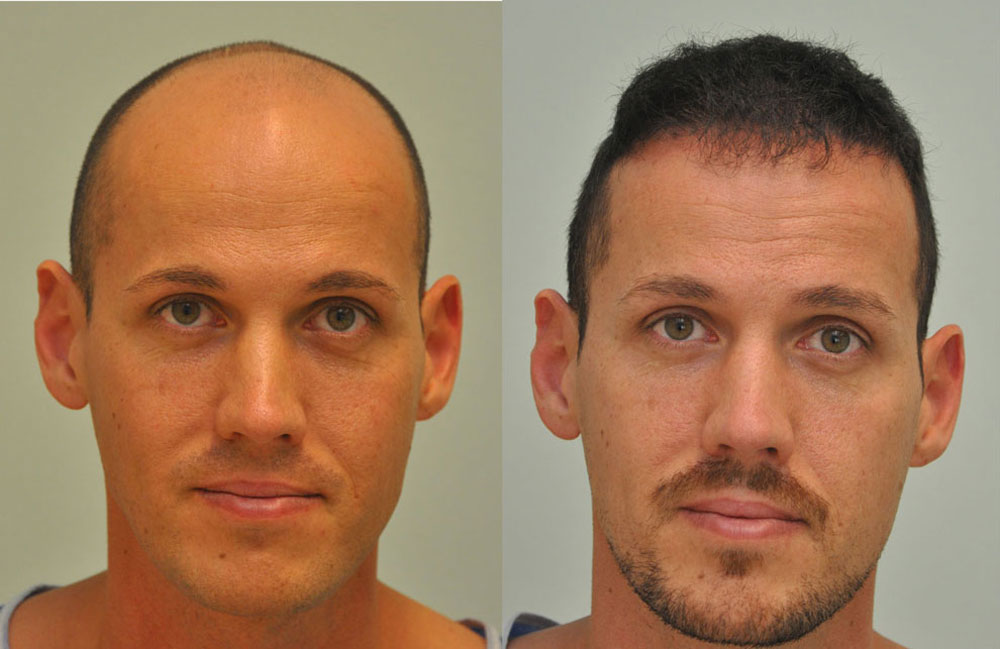 FUE — Dr. Sikos Geza Clinic