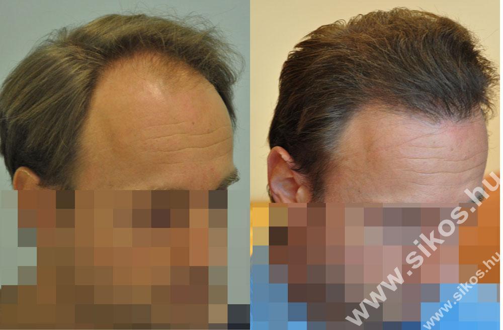 FUE — Dr. Sikos Geza Clinic