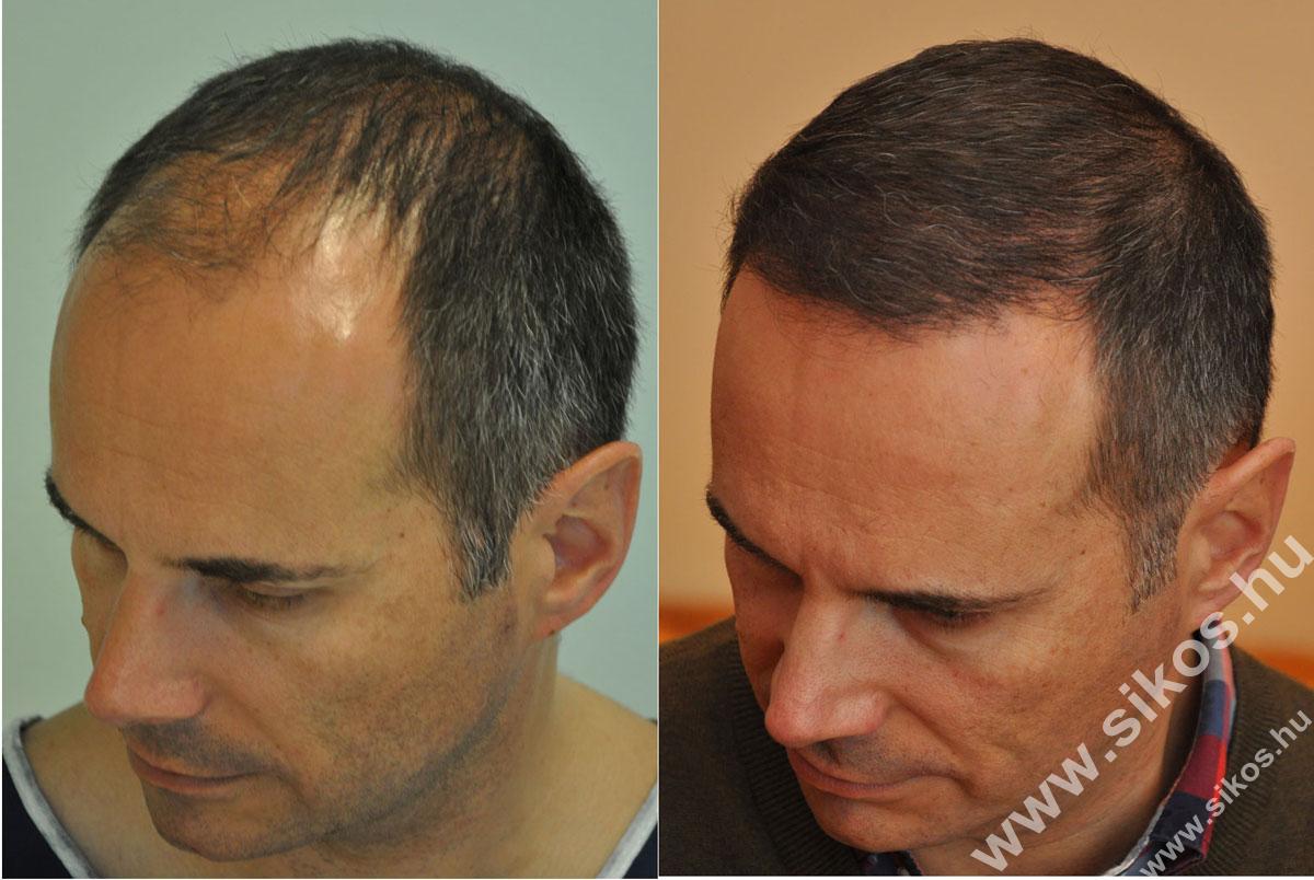 FUE — Dr. Sikos Geza Clinic