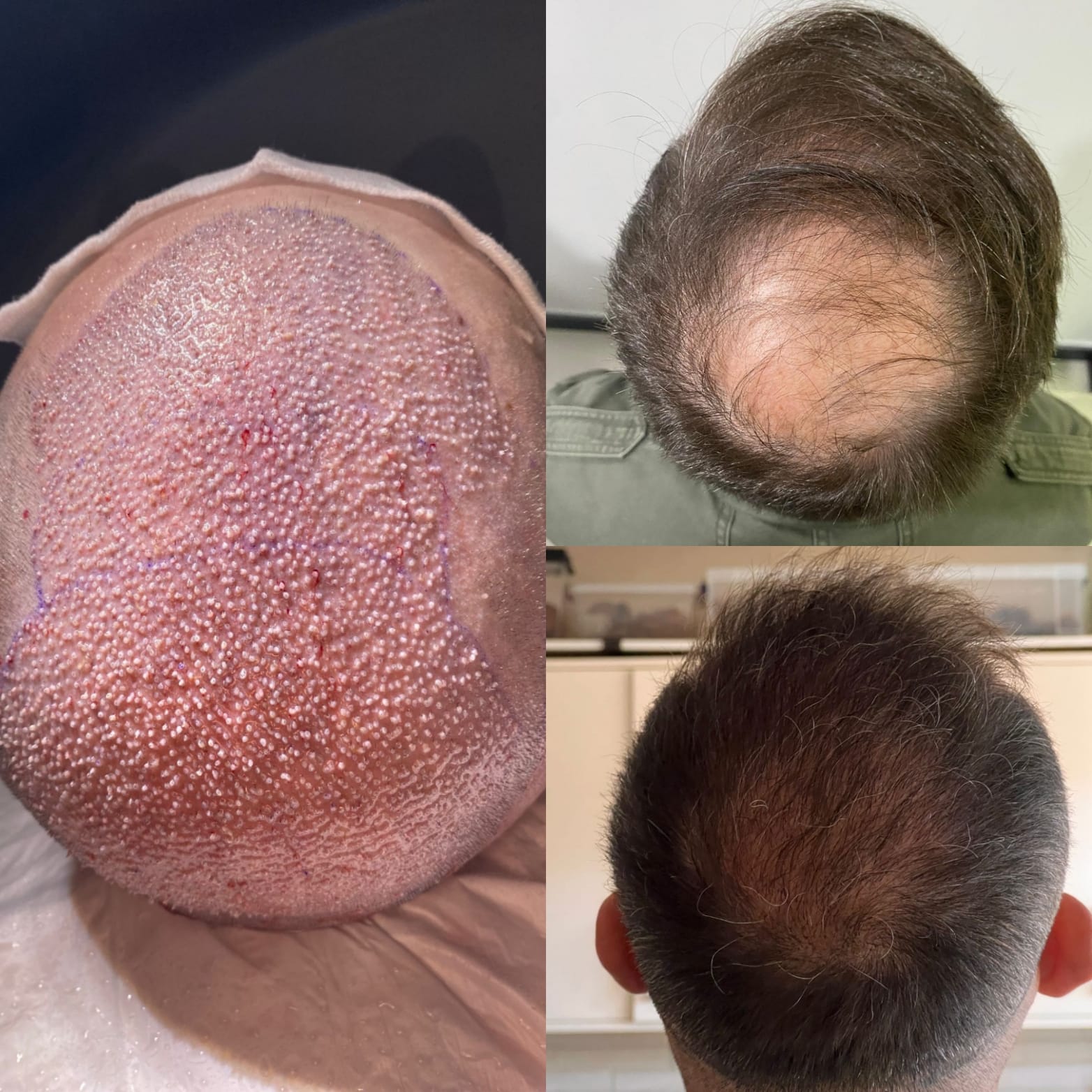 FUE — Hope Hair Health