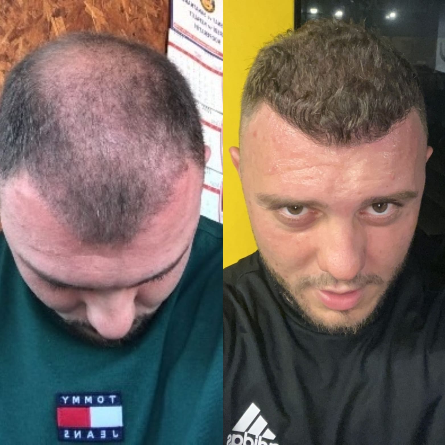 FUE — Hope Hair Health