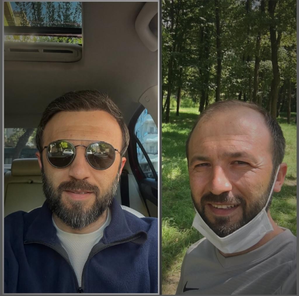 FUE — Hope Hair Health