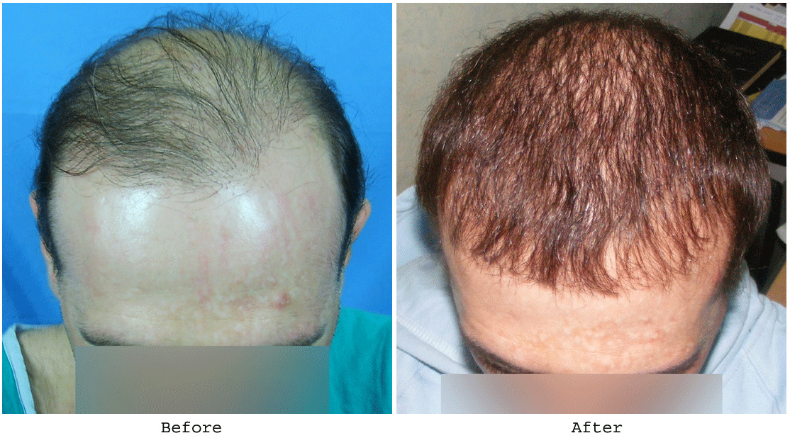 BHT Body Hair Transplant — Dr A's clinic - hair Transplant clinic