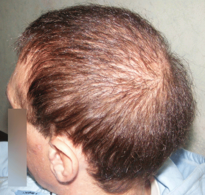 BHT Body Hair Transplant — Dr A's clinic - hair Transplant clinic