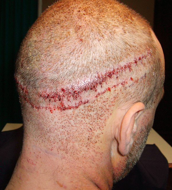 BHT Body Hair Transplant — Dr A's clinic - hair Transplant clinic