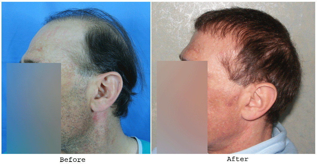 BHT Body Hair Transplant — Dr A's clinic - hair Transplant clinic