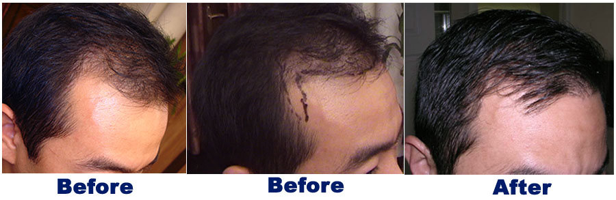 FUE — Dr A's clinic - hair Transplant clinic
