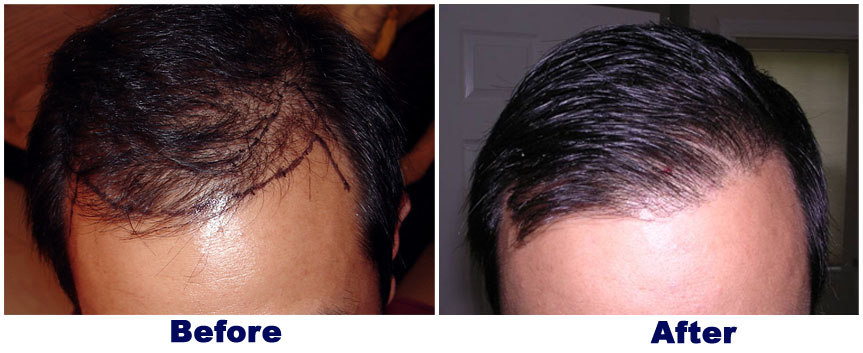 FUE — Dr A's clinic - hair Transplant clinic