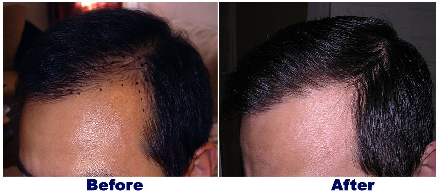 FUE — Dr A's clinic - hair Transplant clinic