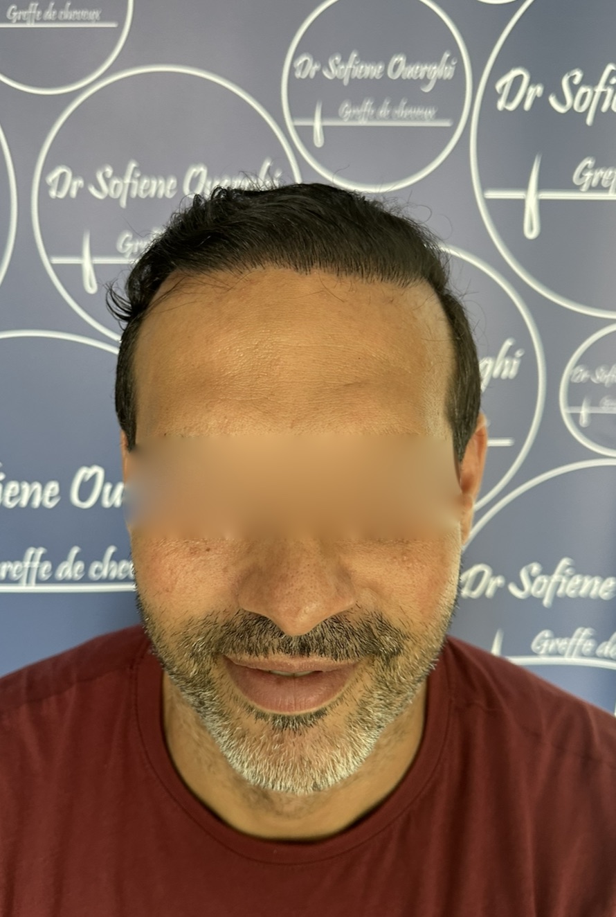 FUE — Dr Sofiene Ouerghi