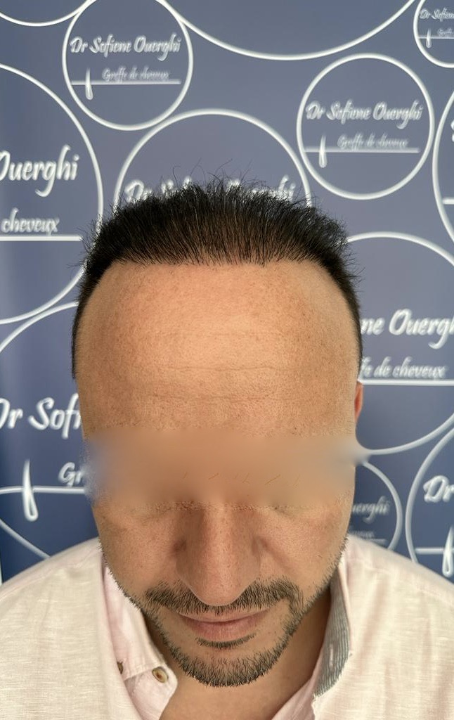 FUE — Dr Sofiene Ouerghi