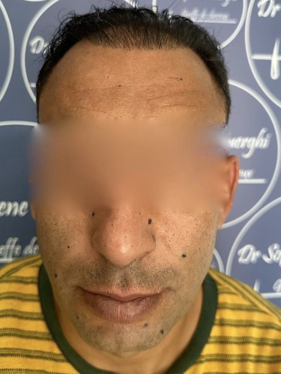 FUE — Dr Sofiene Ouerghi