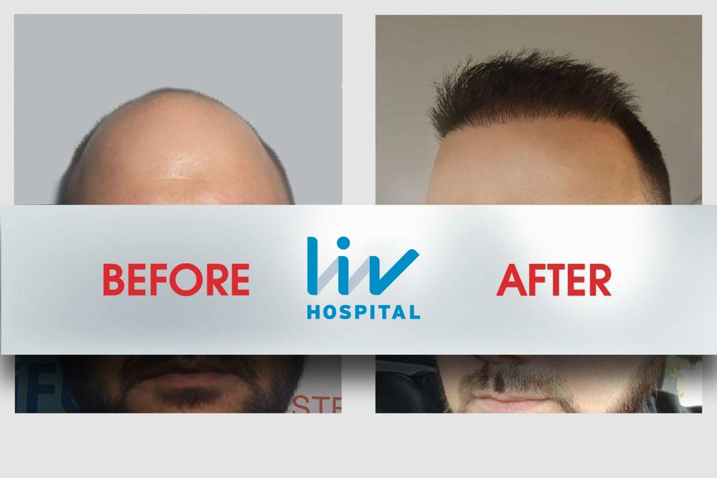 FUE — LIV Hospital