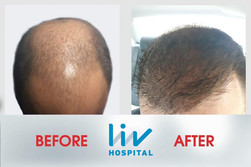 FUE — LIV Hospital