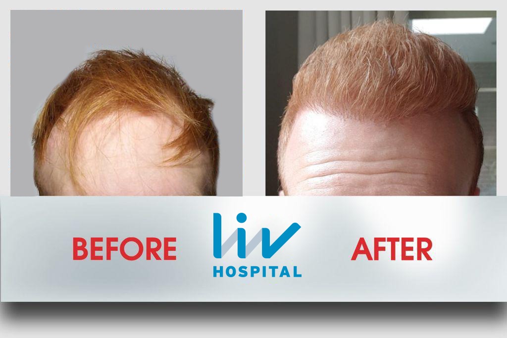 FUE — LIV Hospital
