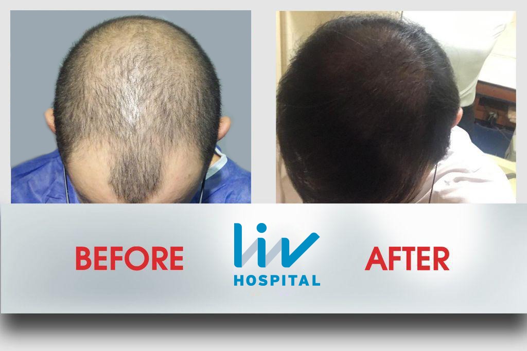 FUE — LIV Hospital
